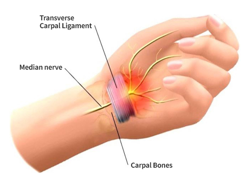 손목 터널 증후군01