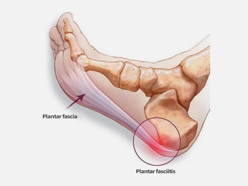 족저 근막염01